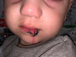 Чем помочь ребенку с рваной раной губы? фото 1