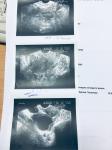 Увеличение яичника, проблемы с зачатием фото 1