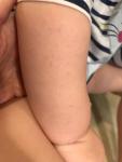Мелкая сыпь на теле у ребёнка фото 2