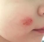 Красное пятно на щеке у ребенка фото 1