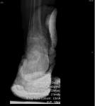 Расшифровка рентгеновского снимка правого голеностопного сустава в двух проекциях фото 1