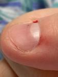 Чёрная точка под ногтем, и кровоизлияние на пальце фото 3