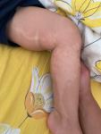 Длинное светлое пятно на ноге у младенца фото 1