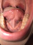 Образование на внутренней поверхности языка и дна полости рта фото 1