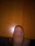 Помогите! Проблема с ногтём большого пальца руки! фото 2