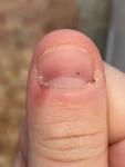 Чёрная точка под ногтем, и кровоизлияние на пальце фото 1