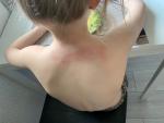 Сыпь у ребенка на спине. Причины возникновения? фото 1