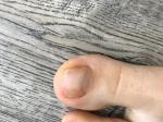 Пятнышко на ногте большого пальца ноги фото 1