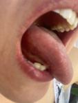 Глоссит, аллергия или воспаление языка фото 3