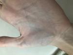 Плотная шишка на вене руки (ладонь), болит при надавливании фото 1