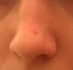 Красное пятно на кончике носа с сосудом фото 1
