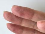 Проблемы с кожей пальцев из за частого воздействия со спиртом фото 1