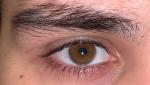 Разные глаза после травмы фото 4