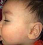 Непреходящая сыпь на лице у ребёнка 10 месяцев! фото 1