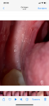 Слизистая рта после операции фото 3