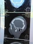 Перелом основания черепа фото 5
