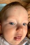 Сыпь на лице у ребёнка фото 1