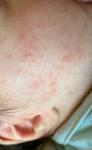 Сыпь у новорождённого аллергия или акне фото 2