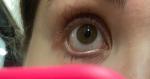 Осложнение на глаза после аллергии фото 4