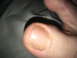 Грибок ногтей на пальце ноги фото 1