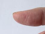 Проблемы с кожей пальцев из за частого воздействия со спиртом фото 3