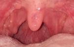 Шишки в горле, опухшие миндалины фото 1