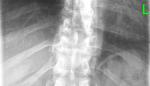 Нижние отделы лёгких на рентгеновском снимке фото 1