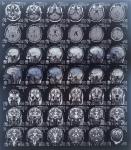 Единичные очаги на МРТ головного мозга фото 1