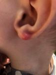 Красный волдырь у ребёнка на мочке уха фото 1