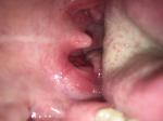 Кровавое воспаление в зоне гланд, острая боль в горле фото 1