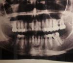 Какой зуб дает боль? фото 1