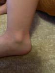 Сыпь на ноге у ребенка и легкий зуд фото 1