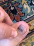 Болезнь ногтей на ногах фото 1