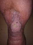 Незаживающая рана на голени фото 2
