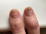 Темные точки на ногтях рук фото 1