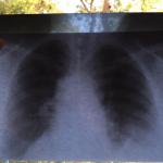 Как выглядит пневмония на снимке рентгена у ребенка фото