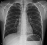Рентген ребёнка, длительный кашель фото 1