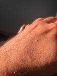 Высыпание на коже рук и пальцев фото 3