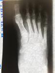 Перелом 5 плюсневой кости у ребёнка 11 лет фото 2