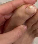 Грибок ногтя на ноге фото 1