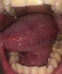 Лейкоплакия полости рта фото 3