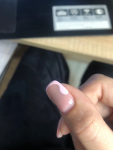 Потемнение ногтевой пластины, отслойка куском фото 1