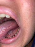 Болит язык после установки временной коронки фото 1