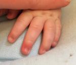Покраснел палец на руке у грудничка фото 3