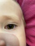 Покраснение белка глаза у ребёнка фото 1