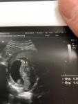 УЗИ при беременности 9 недель фото 1