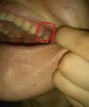 Повреждение десны после свища, воспаление щеки и горло фото 3