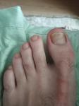 Грибок ногтя ноги парень фото 1