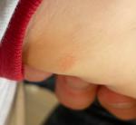 Сухое пятнышко на внутренней стороне руки (почти подмышкой) фото 1