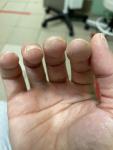 Огрубевшая кожа на кончиках пальцев и кутикулы фото 4